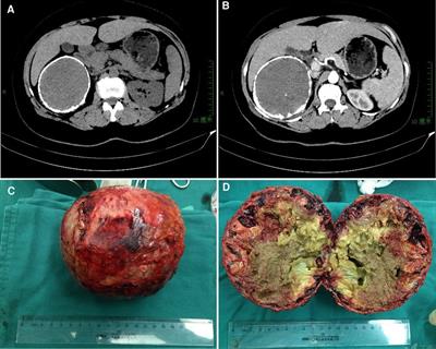 Uncommon abdominal “egg-shelled” lesions mimic hepatic echinococcosis: Two cases report